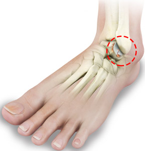 Rheumatoid Arthritis of the Foot and Ankle