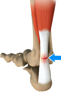 Achilles Tendon Rupture