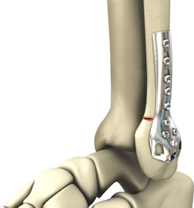 Ankle Fracture Surgery 
