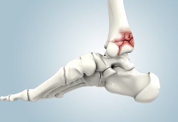 Transfibular Ankle Fusion