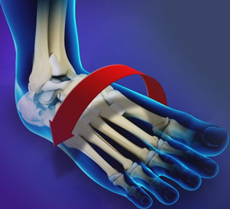 Ankle Instability 