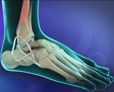 Lateral Ankle Ligament Reconstruction 