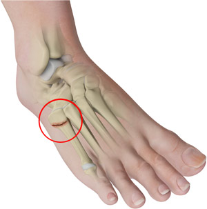 Jones Fractures 