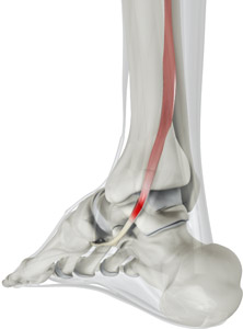 Posterior Tibial Tendon Dysfunction (PTTD)