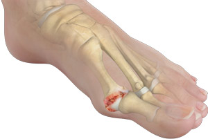 Hallux Rigidus (Stiff Big Toe)