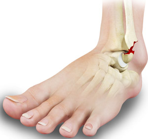 Stress Fractures of the Foot and Ankle 