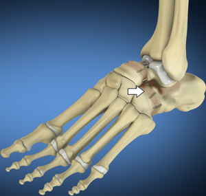 Triple Arthrodesis  